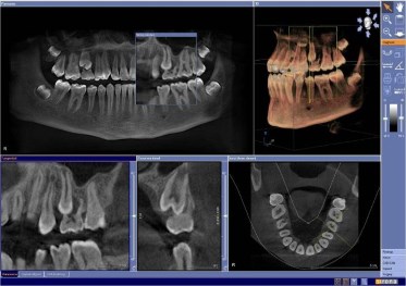 ЗD компьютерная томография зубов в Новостоме