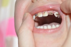 Кариес детских зубов