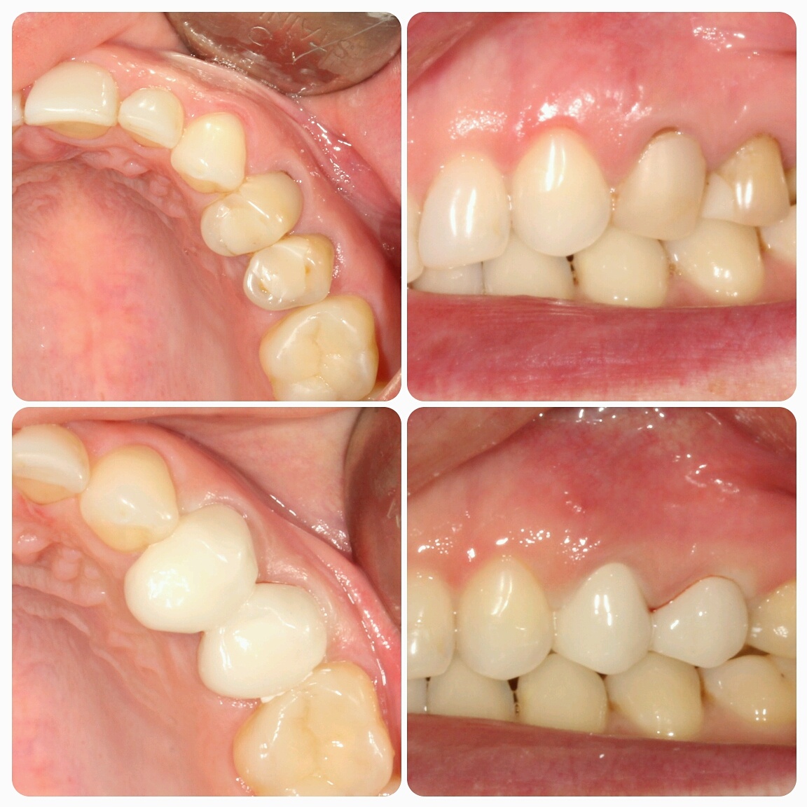 Керамические протезы зуба
