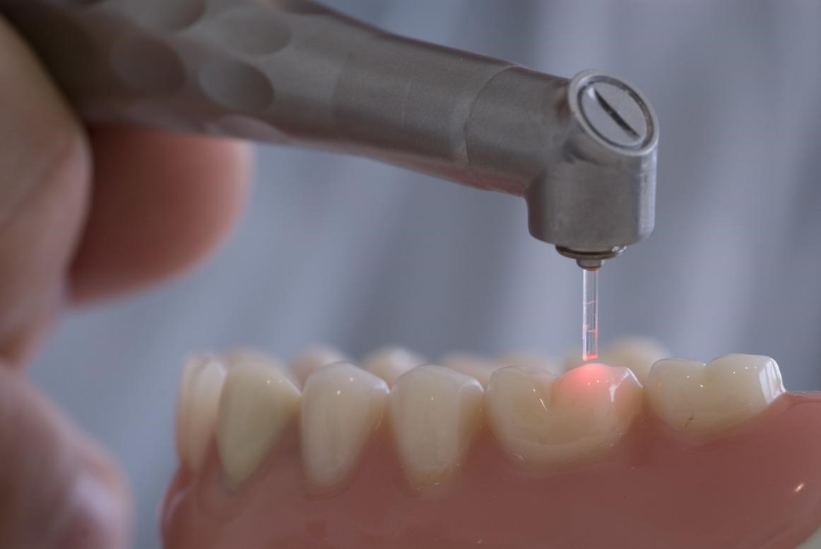 Лечение зуба лазером