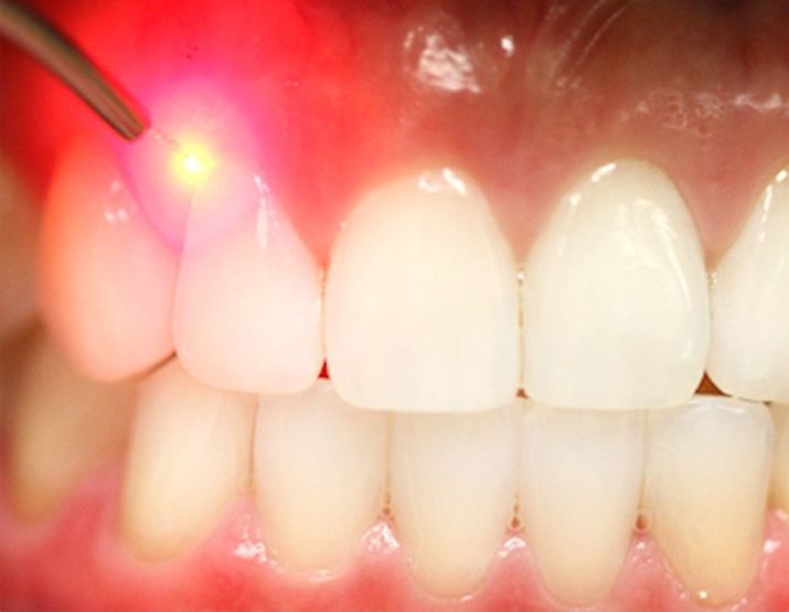 Применение лазера в стоматологии
