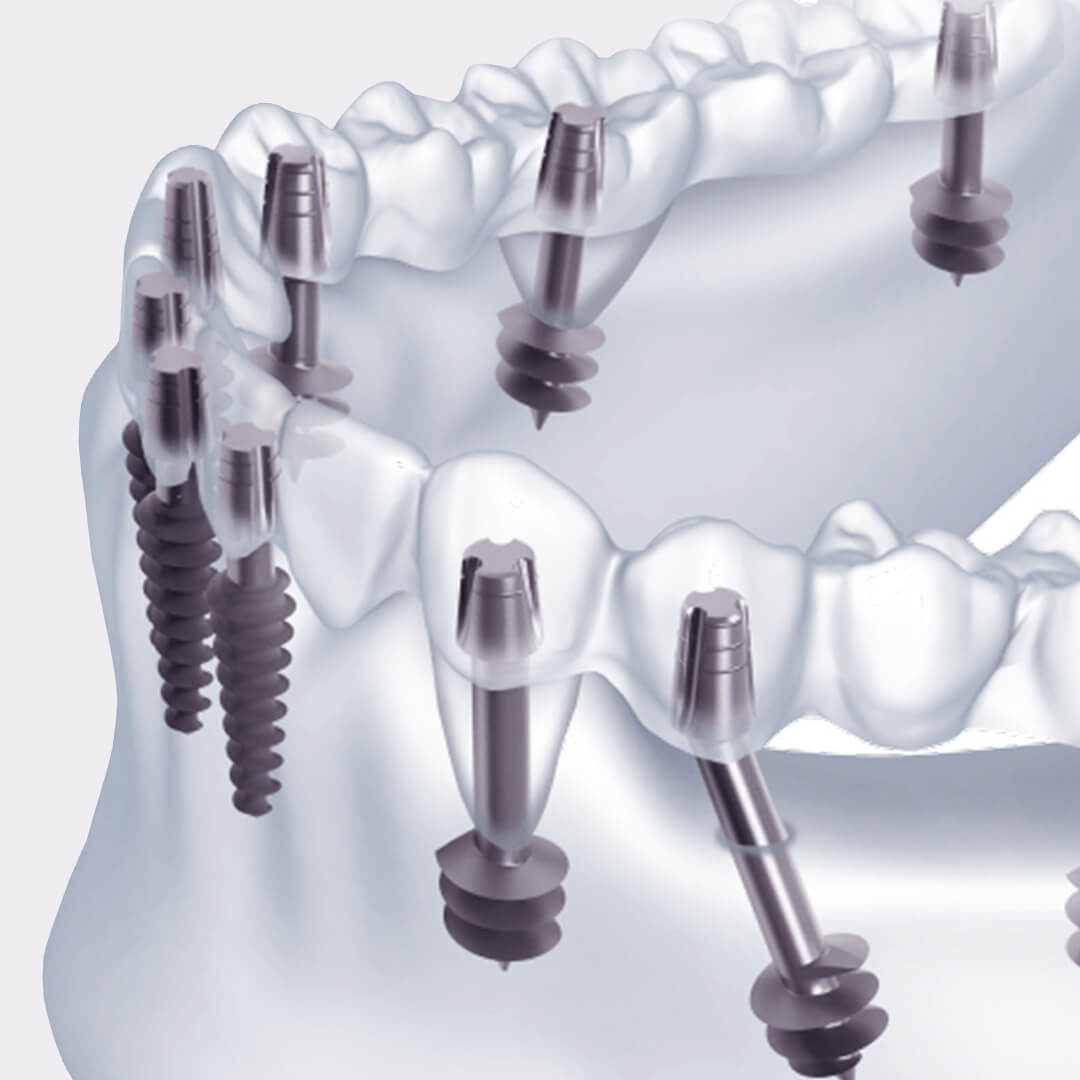 Имплантация зубов виды