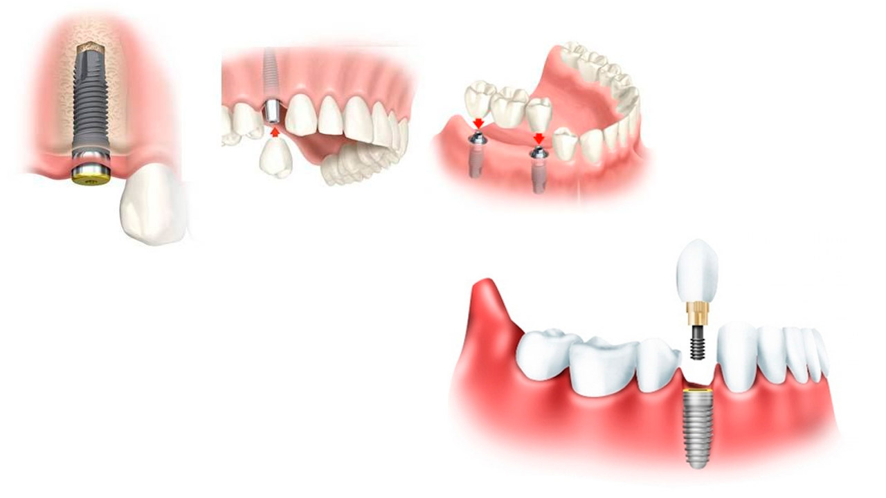 Имплантация зубов виды