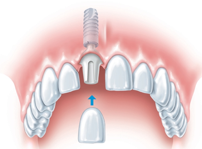 Имплантология в стоматологии