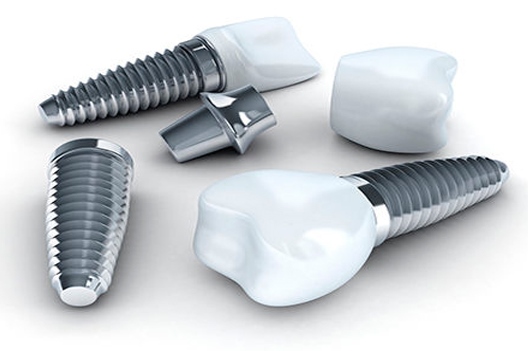 Срок службы имлантов зубов