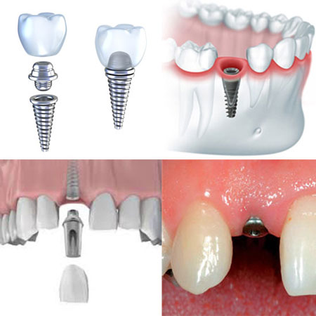 Имплантация зубов этапы установки