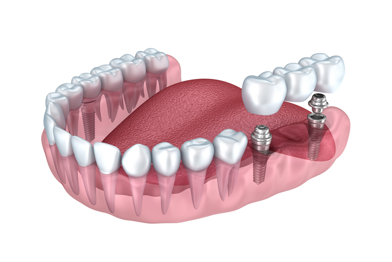 Имплантология зубов