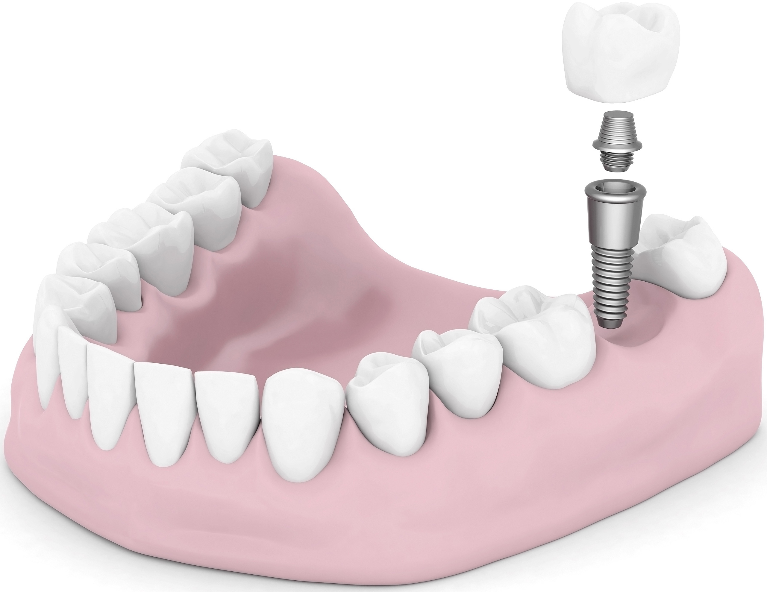 Имплантология зубов