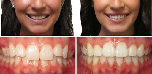 Зубы до и после ношения брекетов