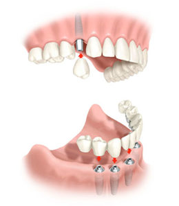Имплантация при полном отсутствии зубов